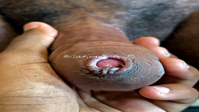 O gordinho com fimose 